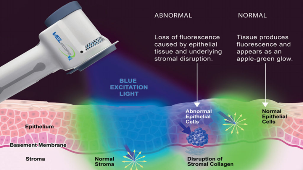 TISSUE FLUORESCENCE Normal Abnormal Edit